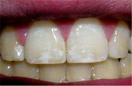 Dental fluorosis